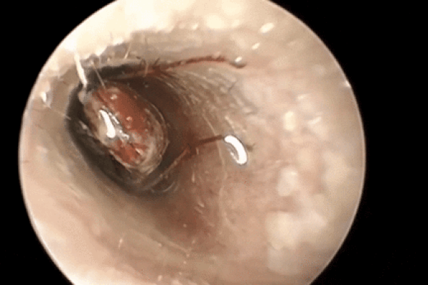 Đau tai đi khám, bác sĩ phát hiện thứ bất ngờ trong tai người đàn ông-1