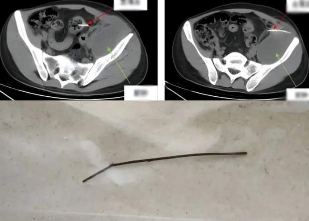 Nuốt nhầm xiên thịt nướng dài 13cm, chàng trai 28 tuổi đau bụng suốt 3 tháng, không thể đi lại-2