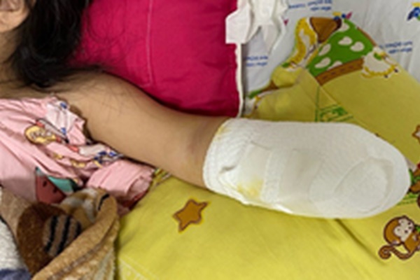 Nhặt pháo hoa nhà hàng xóm đốt, bé gái bị nổ dập nát tay-1