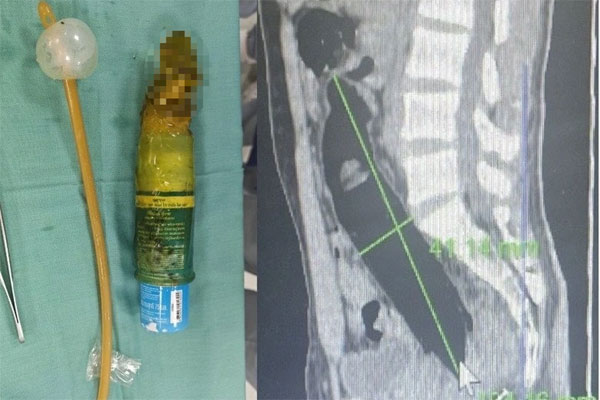 Hà Nội: Kẹt đồ chơi tình dục 23cm, trai trẻ phải cấp cứu giữa Tết-1