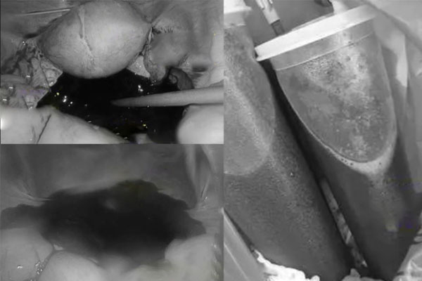 Cô gái cấp cứu giữa đêm valentine vì đau bụng, chảy 1,5 lít máu sau khi làm 1 việc nhiều cặp đôi trẻ thích-2