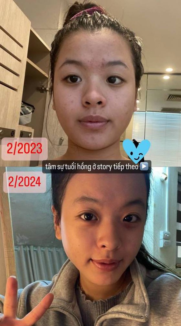 Tiểu thư nhà NSƯT Chiều Xuân tâm sự về khủng hoảng tăng 8kg và da nổi chi chít mụn-2