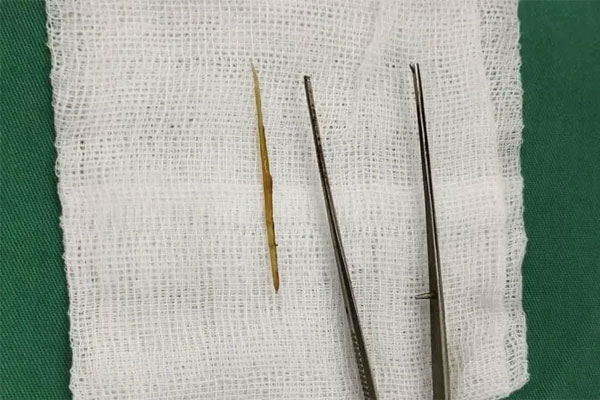 Nuốt phải tăm tre, cô gái bị thủng ruột non-1