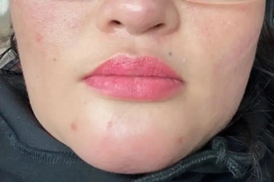 Tiêm filler làm đẹp cằm, người phụ nữ bị chảy mủ trong miệng