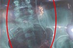 Lâm Đồng: Nhầm kết quả X-quang, bệnh nhân phải thực hiện nội soi tìm dị vật