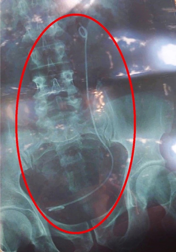 Lâm Đồng: Nhầm kết quả X-quang, bệnh nhân phải thực hiện nội soi tìm dị vật-2