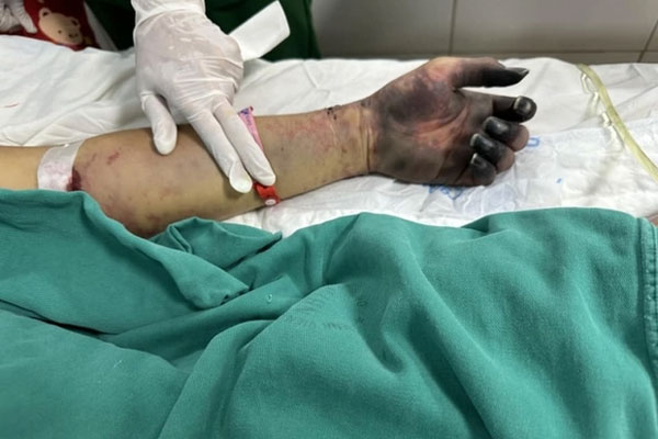 Nam bảo vệ nguy kịch do nhiễm vi khuẩn trong món khoái khẩu-1