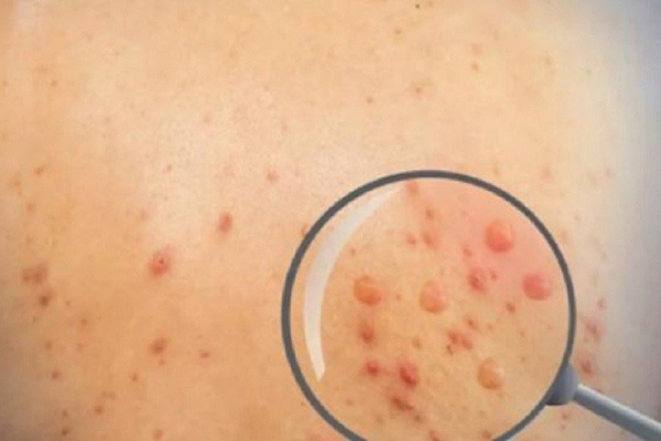 Ca nghi mắc đậu mùa khỉ đầu tiên tại Cà Mau có quan hệ đồng giới không an toàn quen qua app hẹn hò-1