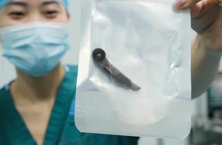 Nhai nắm cỏ đắp vết đứt tay, người đàn ông bị đỉa dài 6 cm chui vào cổ họng-1