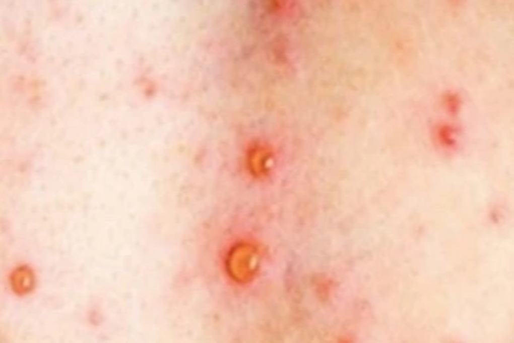 Cà Mau hỏa tốc chỉ đạo phòng, chống sau ca nghi ngờ mắc bệnh đậu mùa khỉ-1