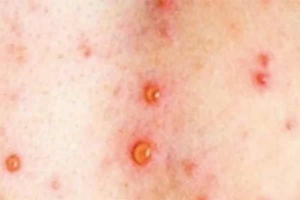 Người đàn ông phải cắt bỏ gần hết dạ dày vì 1 thói quen nhiều người làm mỗi khi đau ốm-3