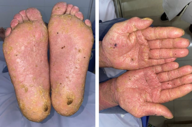 Nhiễm độc thạch tín mạn tính từ thói quen sinh hoạt không ngờ-1