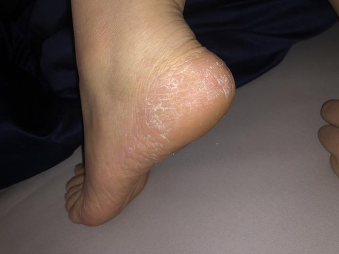 Người may mắn sở hữu thận khỏe sẽ có 3 điểm này trên bàn chân, hãy tự kiểm tra-1