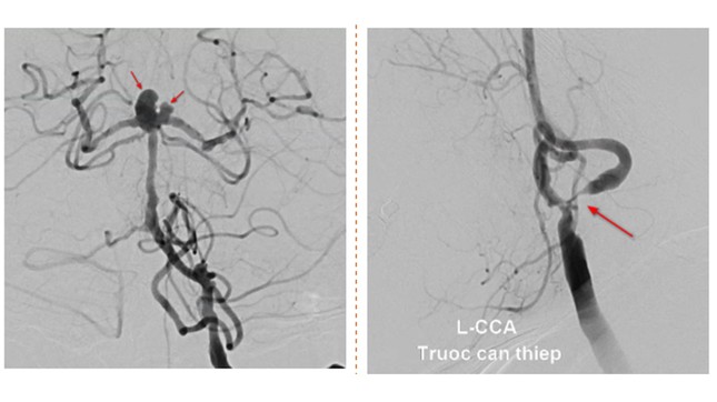 Người phụ nữ bị cùng lúc 2 dạng đột quỵ đặc biệt nguy hiểm-1