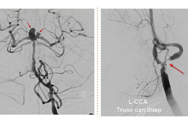 BS cảnh báo 1 thói quen sau khi tập thể dục có thể tăng nguy cơ đột quỵ: Nhiều người chưa biết để tránh-3