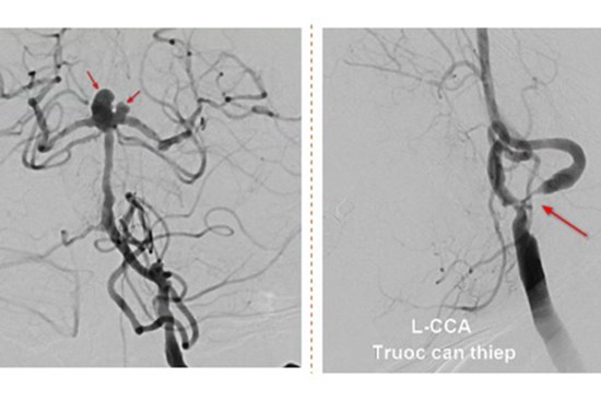 Người phụ nữ bị cùng lúc 2 dạng đột quỵ đặc biệt nguy hiểm