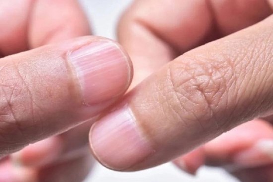 Người thiếu sắt nhìn vào móng tay thấy ngay 3 điểm, hãy mau tự kiểm tra