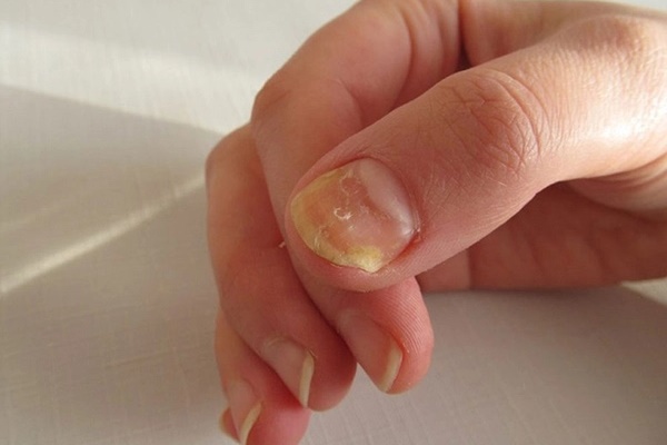 Người thiếu sắt nhìn vào móng tay thấy ngay 3 điểm, hãy mau tự kiểm tra-2