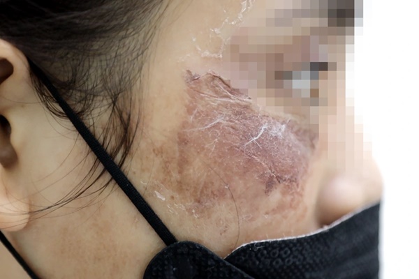 Nỗi đau cô gái biến dạng da nặng: Em không biết họ bắn gì trên mặt-1