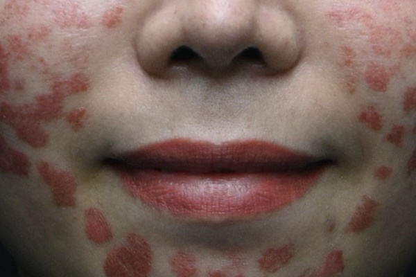 Nỗi đau cô gái biến dạng da nặng: Em không biết họ bắn gì trên mặt-2