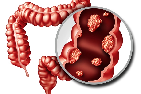 Tiến sĩ Mỹ: Muốn tránh xa ung thư đại tràng, đừng bao giờ mắc phải 4 sai lầm này-2
