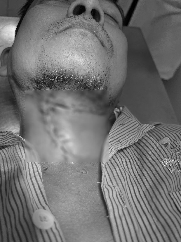 Người đàn ông ở TP.HCM đau răng 10 ngày không khỏi, bác sĩ mở vùng dưới hàm phát hiện cả ổ mủ bốc mùi-1