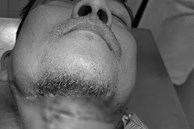 Người đàn ông ở TP.HCM đau răng 10 ngày không khỏi, bác sĩ mở vùng dưới hàm phát hiện cả ổ mủ 'bốc mùi'