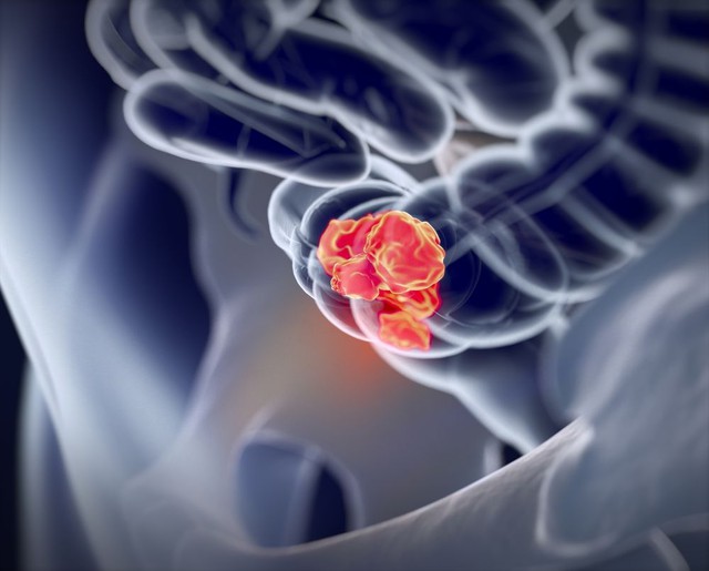 Bỏ qua dấu hiệu đỏ suốt nhiều tháng, người đàn ông phát hiện ung thư giai đoạn 4-1