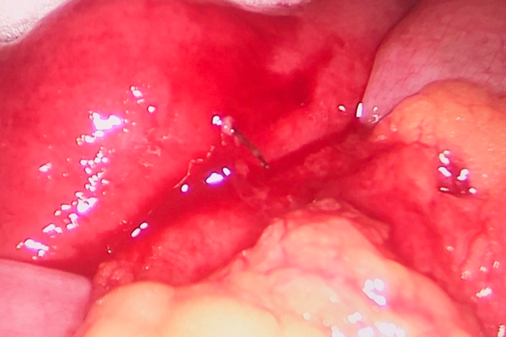 Thiếu nữ thủng ruột vì nuốt nhầm... văn phòng phẩm-2