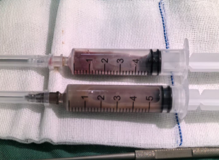 Vi khuẩn phá hủy xương tai giữa, xâm nhập vào não, người đàn ông hối hận vì từng xem nhẹ bệnh-2