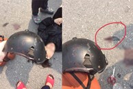 Cô gái ở Hà Nội bị mảnh vỡ của mũ bảo hiểm cắt vào đầu sau va chạm với xe ba gác