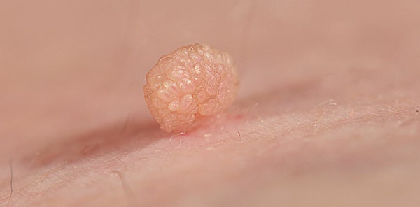 Phụ nữ bị nổi mụn cóc ở 5 vị trí này coi chừng đã nhiễm HPV, tiềm ẩn nguy cơ ung thư cổ tử cung và bệnh tình dục-1