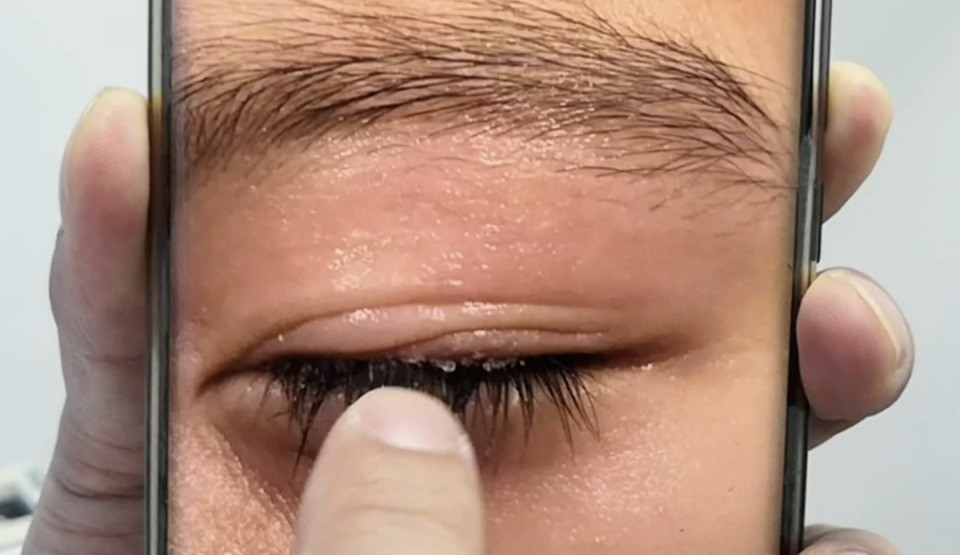 Bé 3 tuổi bị dính keo 502 vào mắt, mẹ làm ngay 2 thao tác cứu được đôi mắt con-2