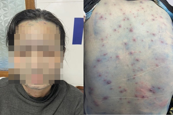 Nữ giáo viên khắp người chi chít mụn nước, gặp biến chứng nặng sau khi lây bệnh từ học sinh-1