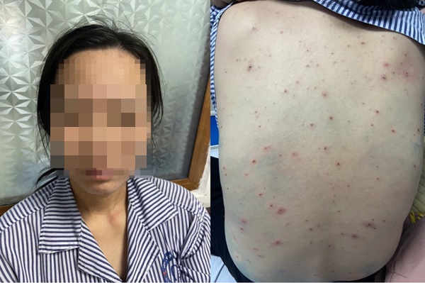 Nữ giáo viên khắp người chi chít mụn nước, gặp biến chứng nặng sau khi lây bệnh từ học sinh-2