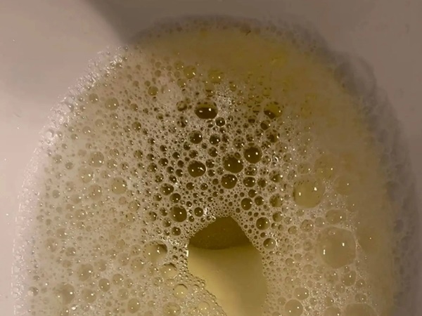 Dấu hiệu thận đang kêu cứu, người trẻ cần đặc biệt chú ý điểm này-5