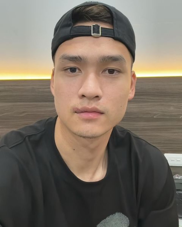 Bùi Hoàng Việt Anh than mồm méo khi cắt chỉ 24 mũi khâu vết rách môi, độ điển trai của nam thần tuyển Việt Nam liệu có sụt giảm?-1