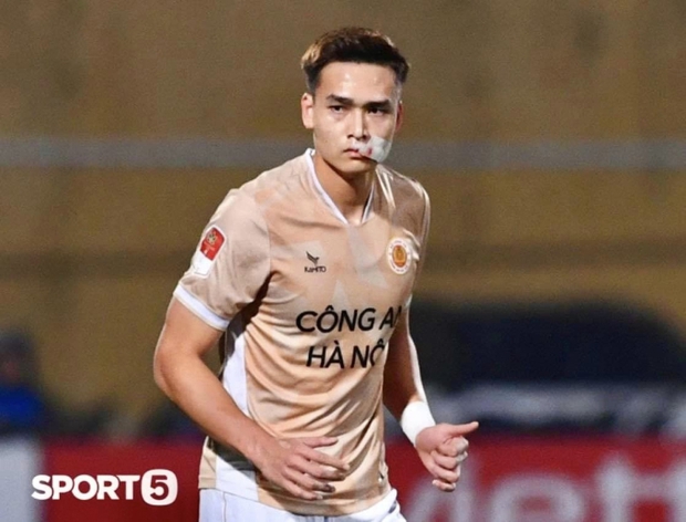 Bùi Hoàng Việt Anh than mồm méo khi cắt chỉ 24 mũi khâu vết rách môi, độ điển trai của nam thần tuyển Việt Nam liệu có sụt giảm?-2