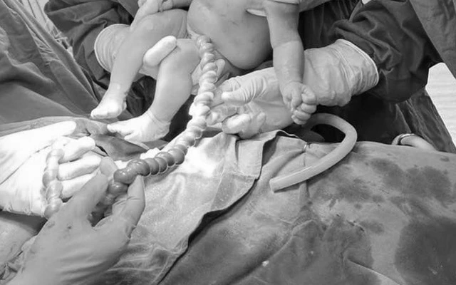 Sản phụ 20 tuổi chuyển dạ, bác sĩ siêu âm giật mình trước hình ảnh bất thường của dây rốn: Mổ lấy thai khẩn cấp!-1