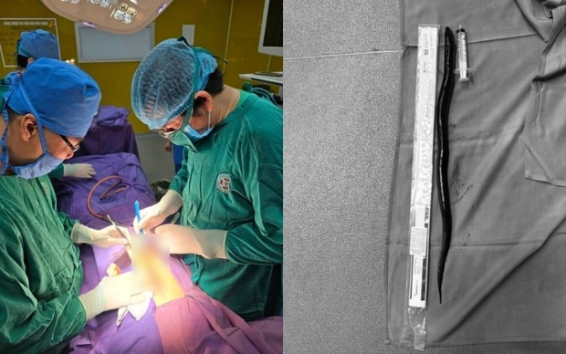 Bác sĩ hãi hùng phát hiện con lươn dài 30 cm trong ổ bụng bệnh nhân khiến một phần trực tràng bị hoại tử, phải làm hậu môn nhân tạo-1