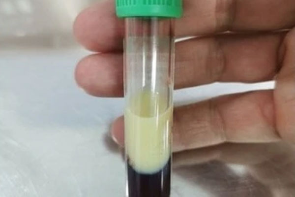 Chàng trai 30 tuổi máu trắng sệt như sữa đặc, món ăn yêu thích của nhiều người là thủ phạm-2