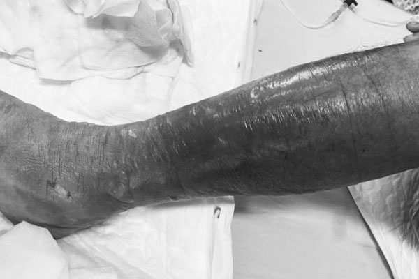 Hoại tử da thịt trong một ngày vì đi chân trần lội nước-1