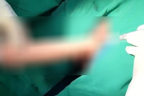 Dương vật giả mắc kẹt trong trực tràng nam thanh niên 23 tuổi