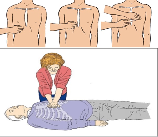 Từ vụ nữ điều dưỡng cứu du khách ngưng thở: Xử lý sao với các tình huống nguy cấp về tim mạch?-1