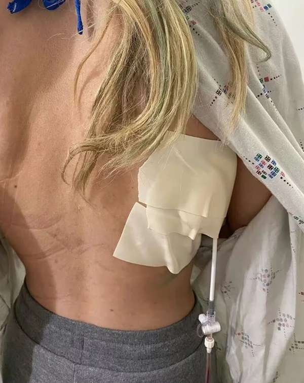 Phổi bẹp dúm, đầy sẹo vĩnh viễn, cô gái 20 tuổi hối hận vì đã làm 1 điều suốt 5 năm-2