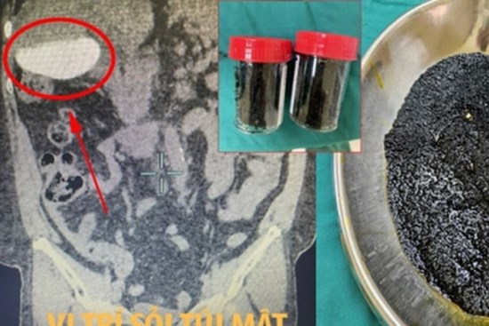 Choáng với số lượng viên sỏi nhiều không đếm xuể khi cắt túi mật cho người phụ nữ ở Vĩnh Long