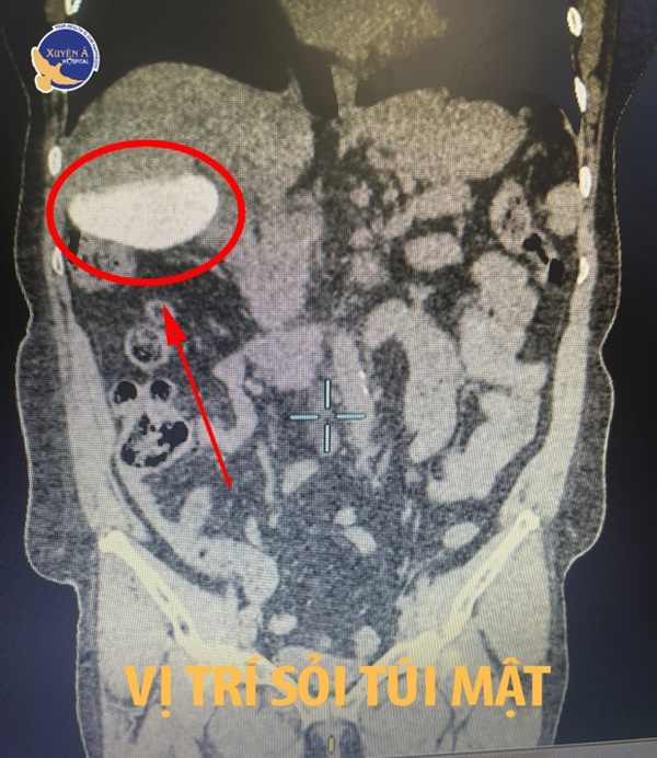 Choáng với số lượng viên sỏi nhiều không đếm xuể khi cắt túi mật cho người phụ nữ ở Vĩnh Long-1