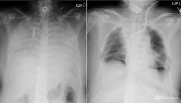 Chụp X-quang phát hiện nhiều người trẻ phổi trắng xóa, nguyên nhân vì đâu?-1