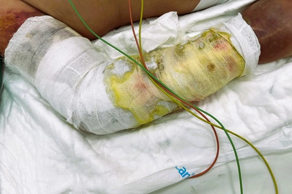 Sau khi đá bóng, nam sinh bất ngờ bị hoại tử xương vì chủ quan với một thứ-2