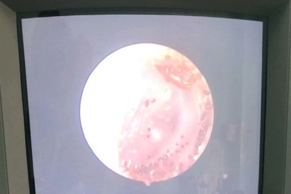 Lấy ve chó kèm tổ trứng trong tai bệnh nhân 13 tuổi-1